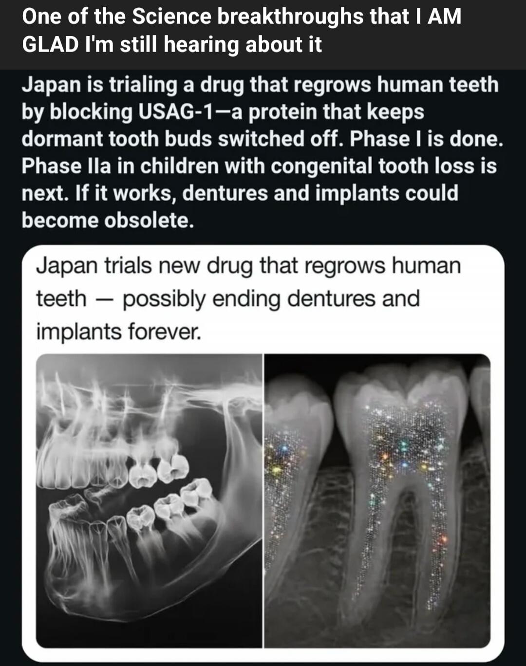 One of the Science breakthroughs that I AM GLAD I'm still hearing about it. Japan is trialing a drug that regrows human teeth by blocking USAG-1—a protein that keeps dormant tooth buds switched off. Phase I is done. Phase IIa in children with congenital tooth loss is next. If it works, dentures and implants could become obsolete. Japan trials new d