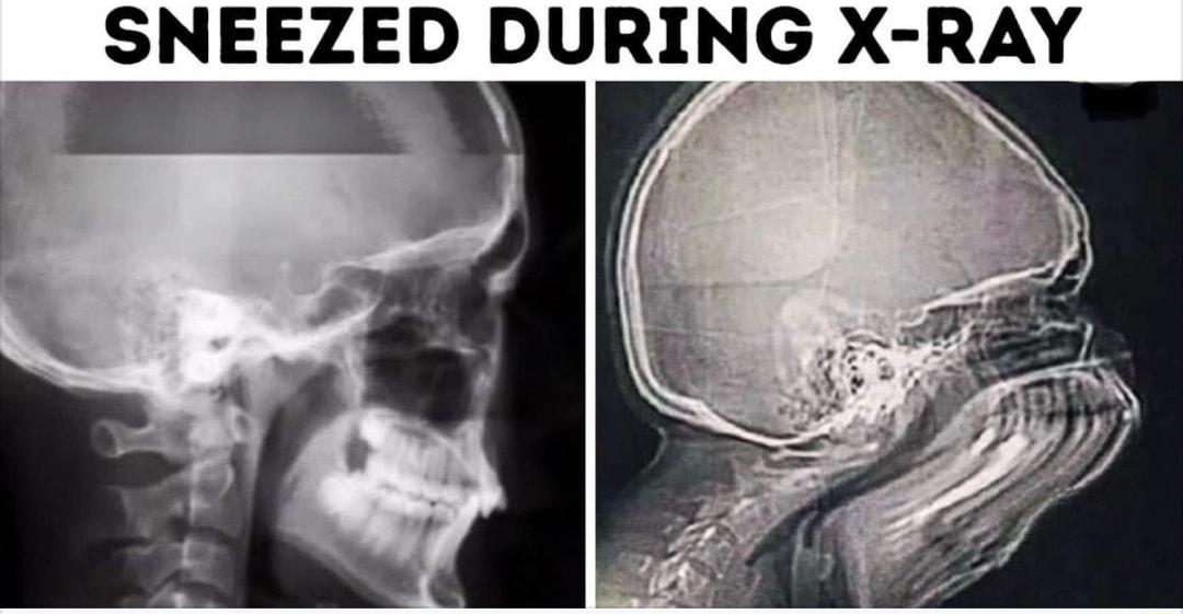 SNEEZED DURING X RAY Y