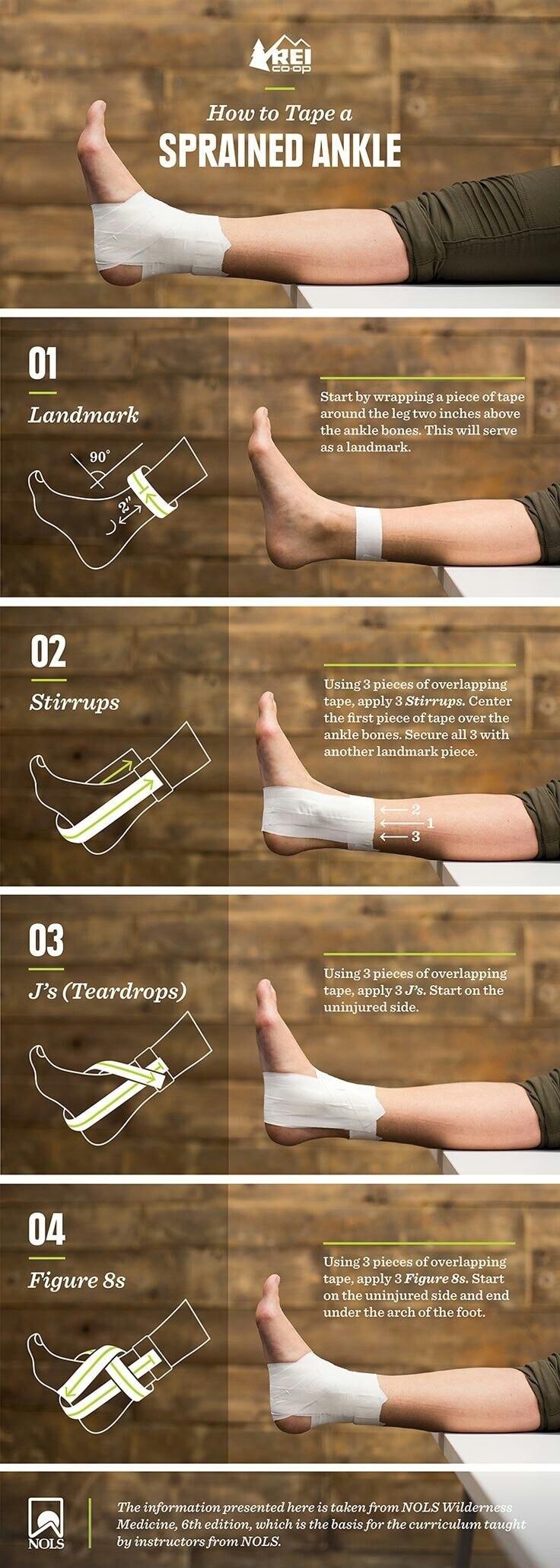 o How ta_Tape a SPRAINED ANKLE 1 5 Start by wrsppingapice oftape Landmark B around the eg two inchesabove the ankle bones This wil serve as alandmark Using3 plates of overlapping tape apply 3 Stirrups Center thefirst ploce oftape over the ankle bones Secure all S with anotherlandmask piece Gsiedo bilesor overappistl s Teardrops ey spply 37 Strtonthe uninjuredside 04 el T L Figure8s apesoply 3 Figu
