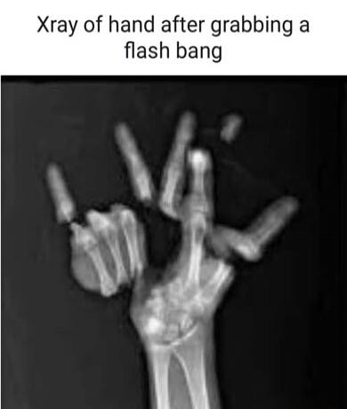 Xray of hand after grabbing a flash bang