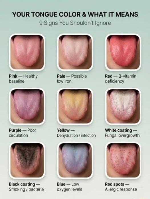 YOUR TONGUE COLOR & WHAT IT MEANS 9 Signs You Shouldn't Ignore Pink — Healthy baseline Pale — Possible low iron Red — B-vitamin deficiency Purple — Poor circulation Yellow — Dehydration / infection White coating — Fungal overgrowth Black coating — Smoking / bacteria Blue — Low oxygen levels Red spots — Allergic response