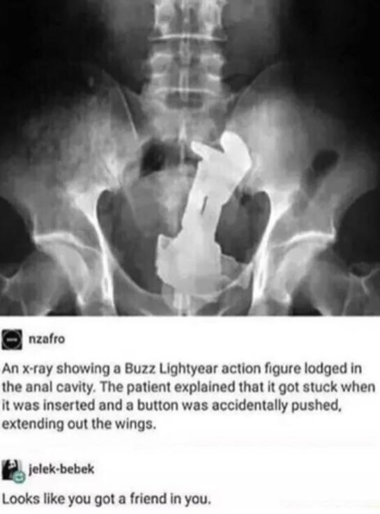 nzafro An x ray showing a Buzz Lightyear action figure lodged in the anal cavity The patient explained that it got stuck when it was inserted and a button was accidentally pushed extending out the wings Jelek bebek Looks like you got a friend in you