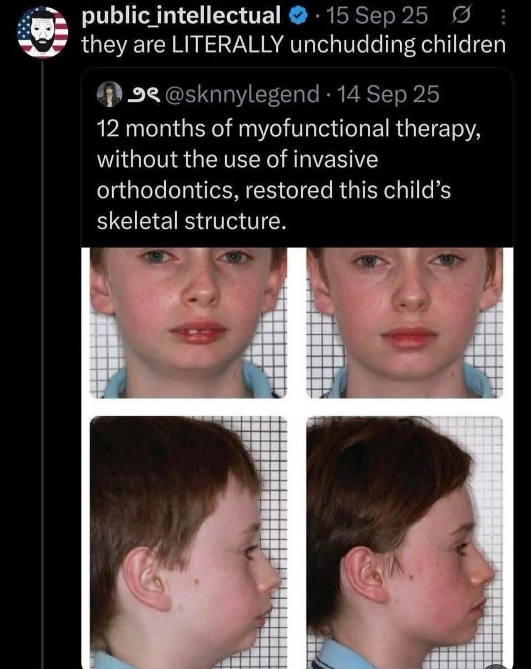 they are LITERALLY unchudding children

12 months of myofunctional therapy, without the use of invasive orthodontics, restored this child's skeletal structure.