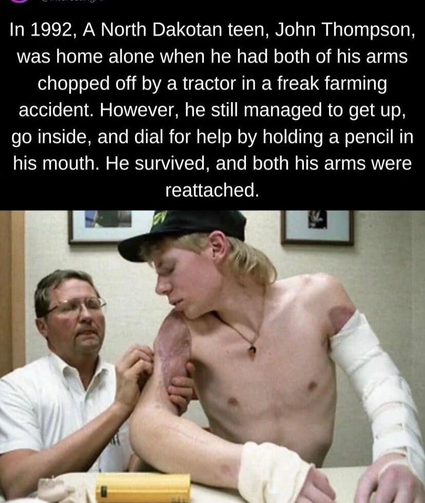 In 1992 A North Dakotan teen John Thompson was home alone when he had both of his arms chopped off by a tractor in a freak farming accident However he still managed to get up go inside and dial for help by holding a pencil in his mouth He survived and both his arms were CEUET N