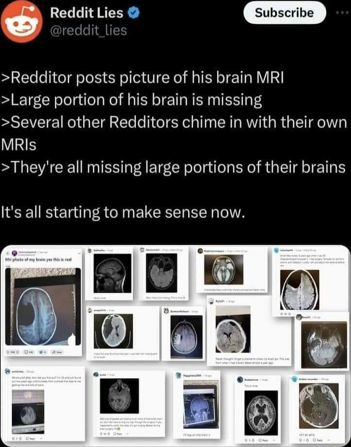 6 Reddit Lies Redditor posts picture of his brain MRI Large portion of his brain is missing Several other Redditors chime in with their own MRIs Theyre all missing large portions of their brains RS A NN EUCEERER A