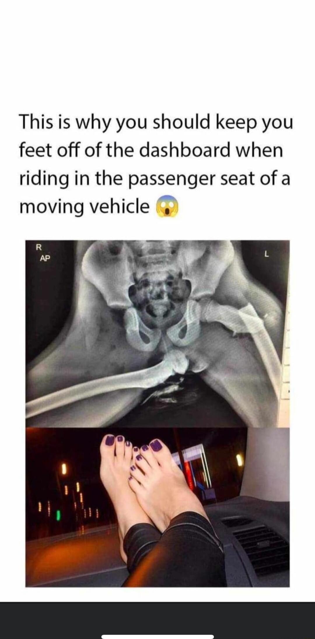 This is why you should keep you feet off of the dashboard when riding in the passenger seat of a moving vehicle