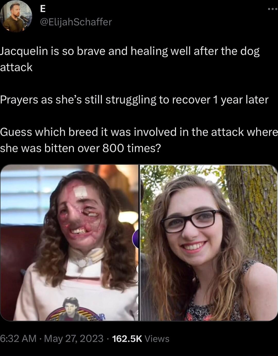 3 ElijahSchaffer Jacquelin is so brave and healing well after the dog attack Prayers as shes still struggling to recover 1 year later Guess which breed it was involved in the attack where she was bitten over 800 times