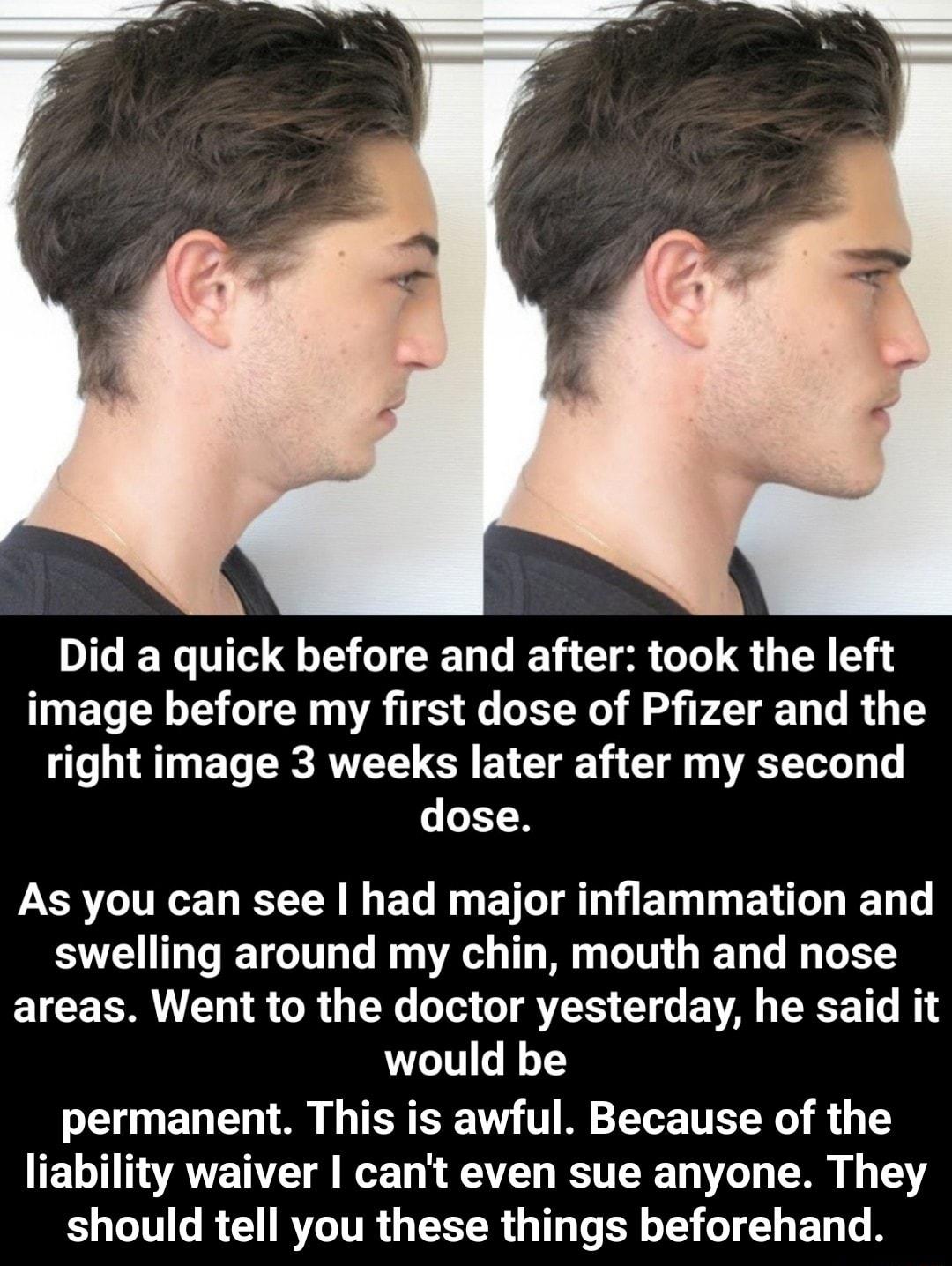 Did a quick before and after took the left image before my first dose of Pfizer and the right image 3 weeks later after my second dose RN R G E T BTl T T E T E L e 1y swelling around my chin mouth and nose areas Went to the doctor yesterday he said it would be permanent This is awful Because of the liability waiver cant even sue anyone They should tell you these things beforehand