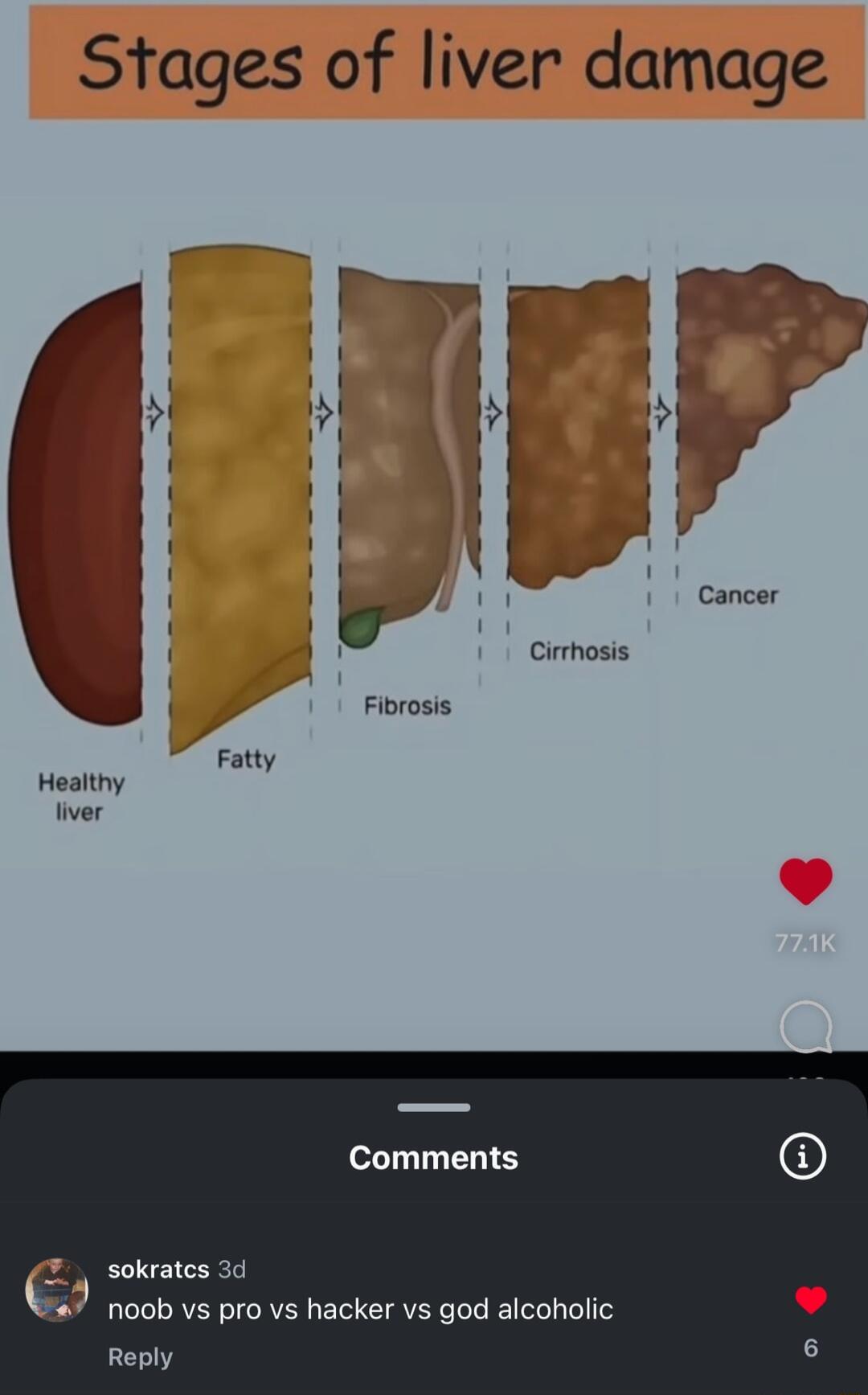 Stages of liver damage q q Cirrhosis f Fibrosis Fatty Healthy Comments 6 sokrates 3d 7 noob vs pro vs hacker vs god alcoholic Reply