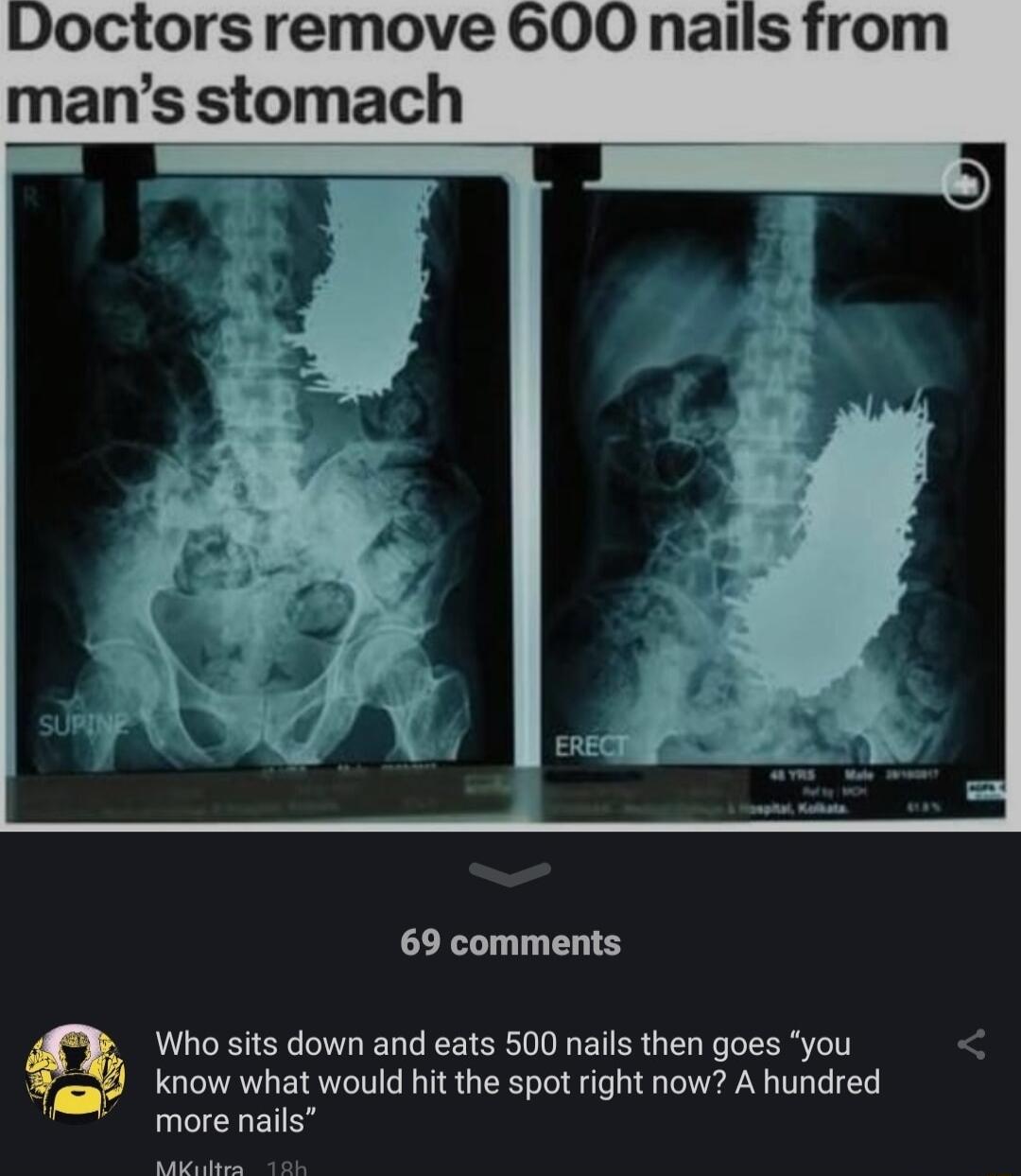 Doctors remove 600 nails mans stomach 69 comments Who sits down and eats 500 nails then goes you know what would hit the spot right now A hundred more nails