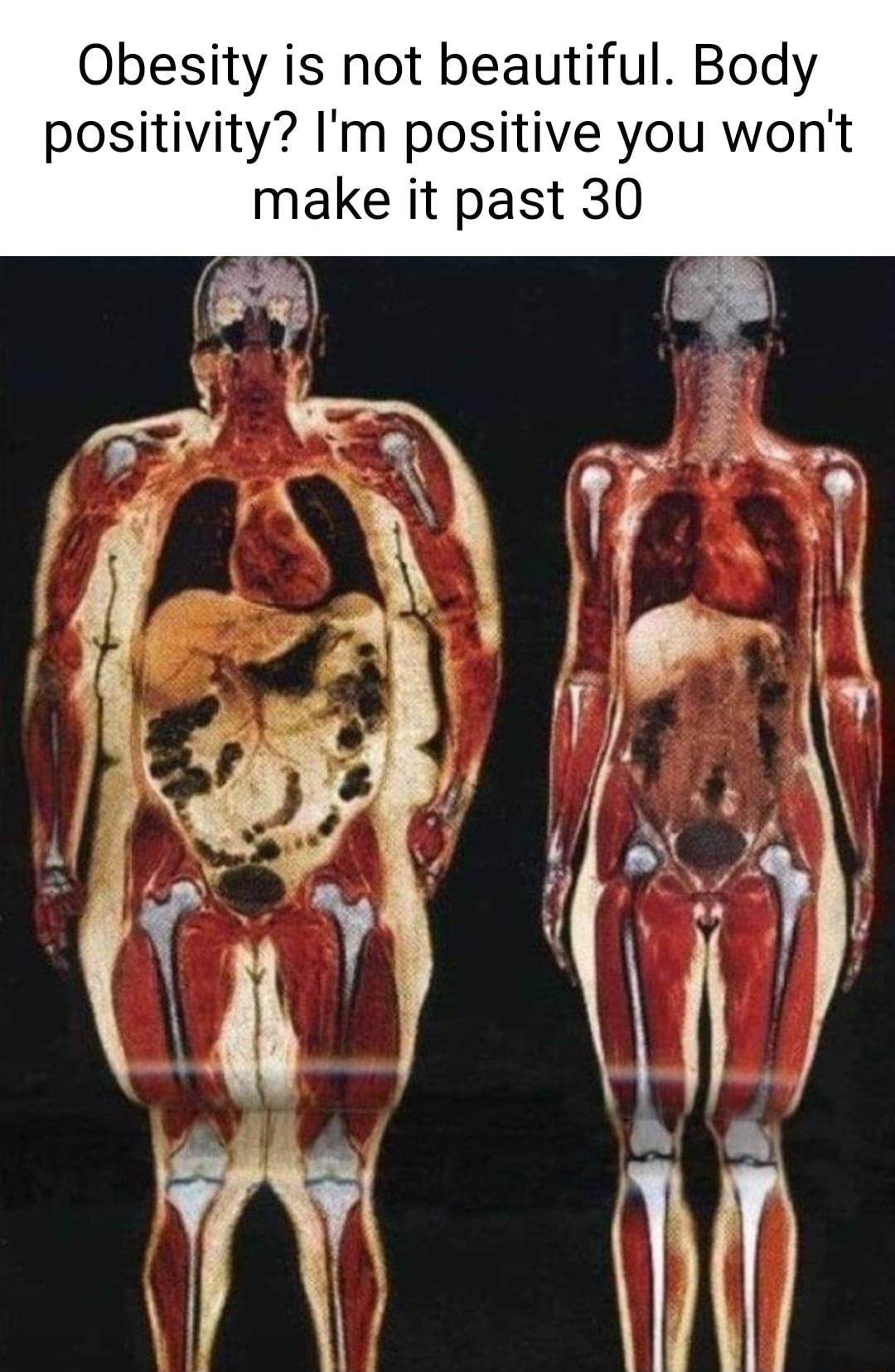 Obesity is not beautiful Body positivity Im positive you wont make it past 30
