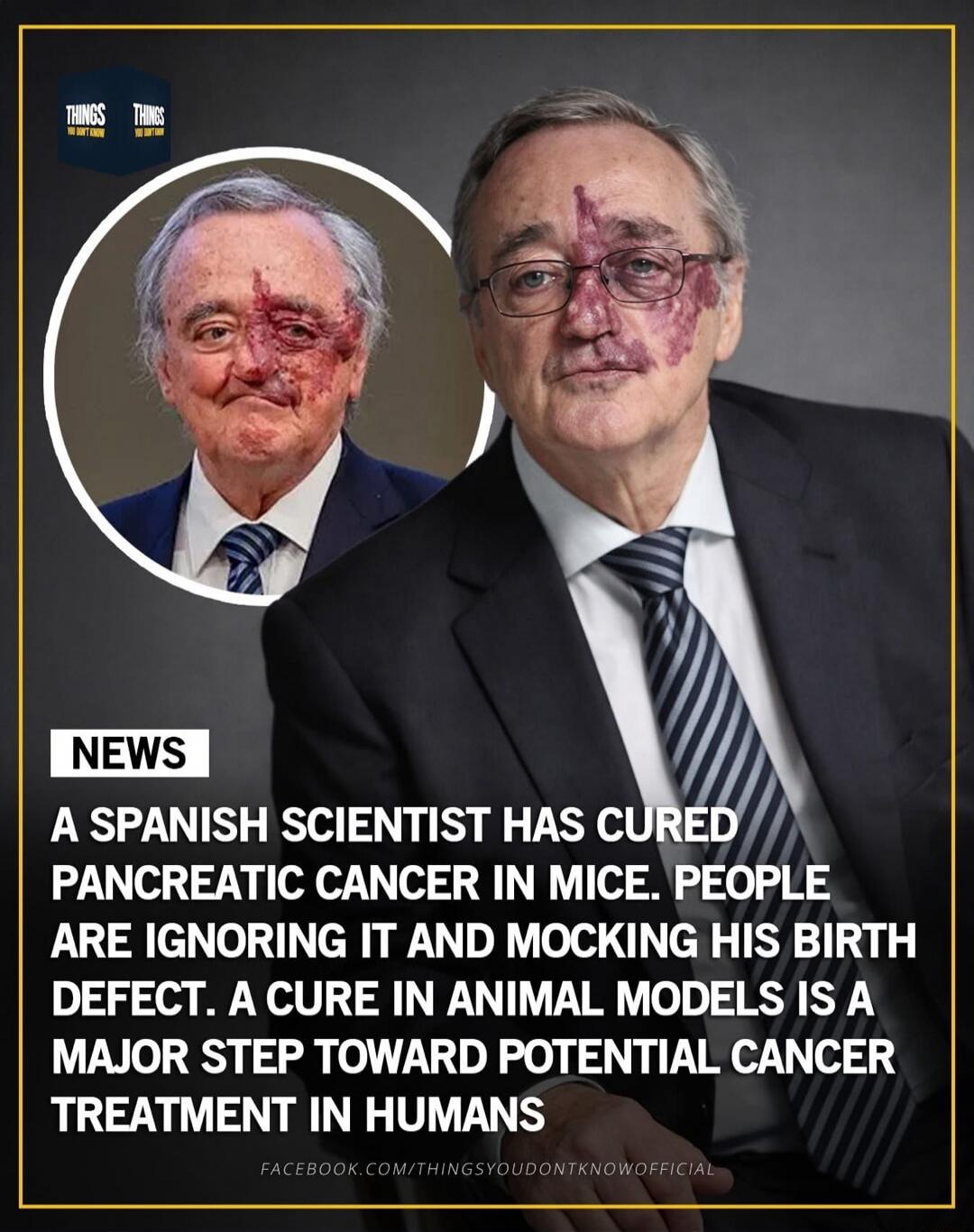 NEWS A SPANISH SCIENTIST HAS CURED PANCREATIC CANCER IN MICE. PEOPLE ARE IGNORING IT AND MOCKING HIS BIRTH DEFECT. A CURE IN ANIMAL MODELS IS A MAJOR STEP TOWARD POTENTIAL CANCER TREATMENT IN HUMANS