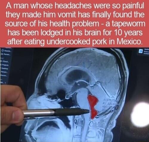 A man whose headaches were so pail made him vomit has finally found the source of his health problem a tapeworm has been lodged in his brain for 10 years after eating undercooked pork in Mexico L o