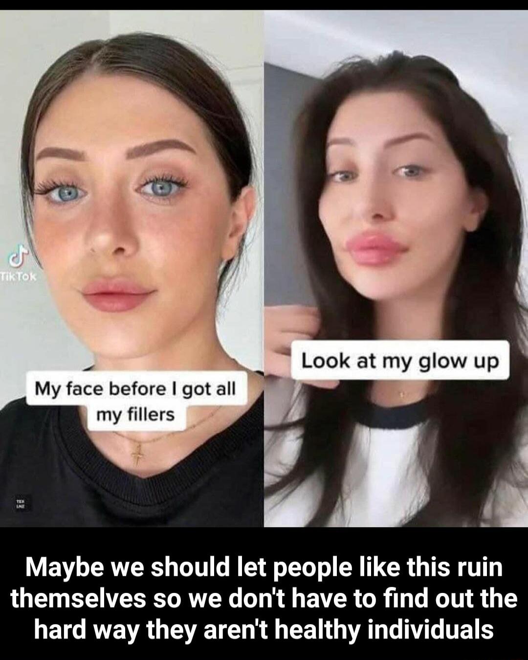 My face before got all my fillers I Maybe we should let people like this ruin QOET EENEEEL Y L G EIERCR LG 8 1 LELGRVEVRG T G CEN VAL LAY TR