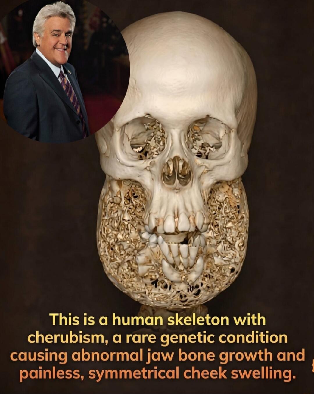 This is a human skeleton with cherubism, a rare genetic condition causing abnormal jaw bone growth and painless, symmetrical cheek swelling.