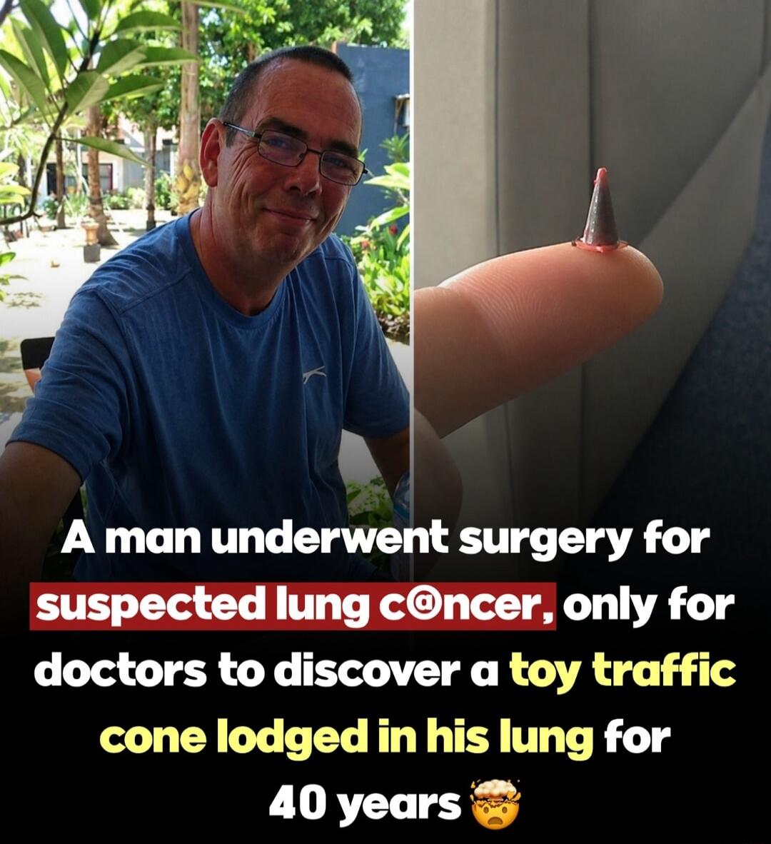 A man underwent surgery for suspected lung cancer, only for doctors to discover a toy traffic cone lodged in his lung for 40 years 🤯