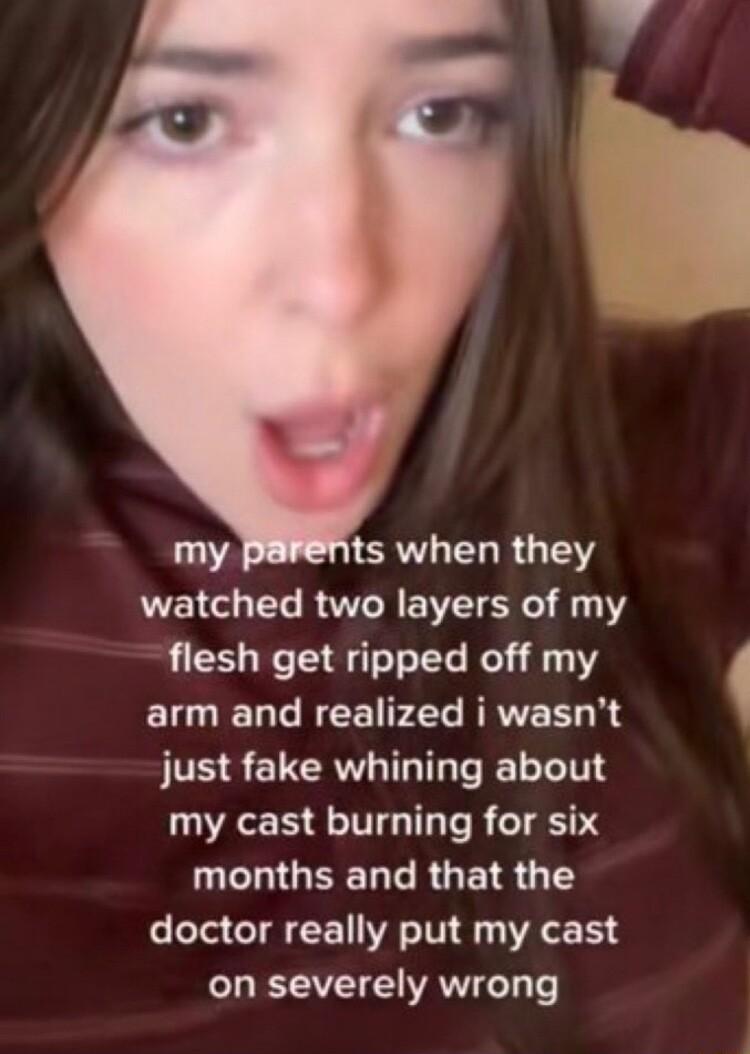 111 ts when they watched two layers of my flesh get ripped off my arm and realized i wasnt just fake whining about my cast burning for six I GEERGRGEIS 1 doctor really put my cast on severely wrong