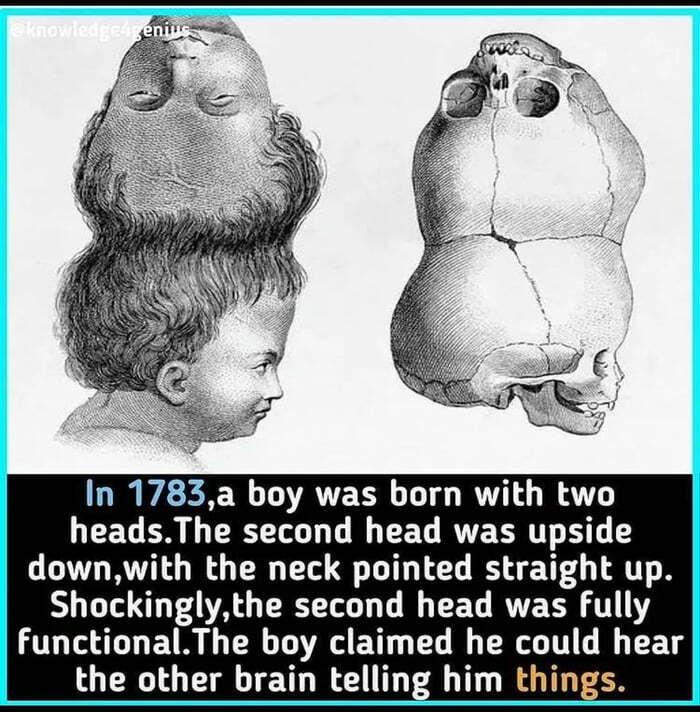 In 1783a boy was born with two EET BN G RLT T G TET RECRT T T downwith the neck pointed straight up ST T P A G ERSTG T G EET R RN T TL TS ETR G R TOA EY G L G R T TR T the other brain telling him things