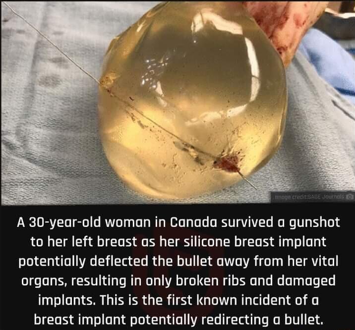 A 30 year old woman in Canada survived a gunshot to her left breast as her silicone breast implant potentially deflected the bullet away from her vital organs resulting in only broken ribs and damaged implants This is the first known incident of a breast implant potentially redirecting a bullet