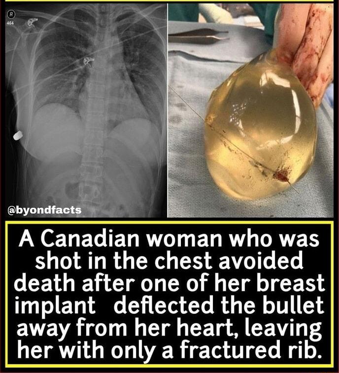 oty LU EL ELRVIGET RV AVET shot in the chest avoided death after one of her breast implant deflected the bullet EVEVALC TN Ul Ty ST 4 her with only a fractured rib