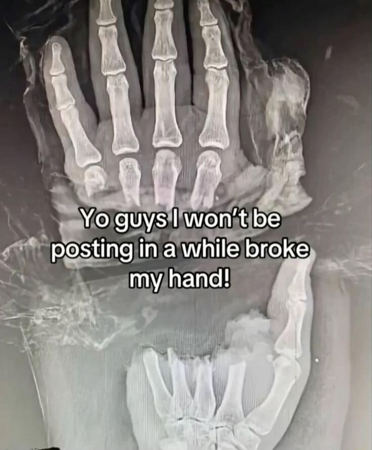 Yo guys I won't be posting in a while broke my hand!
