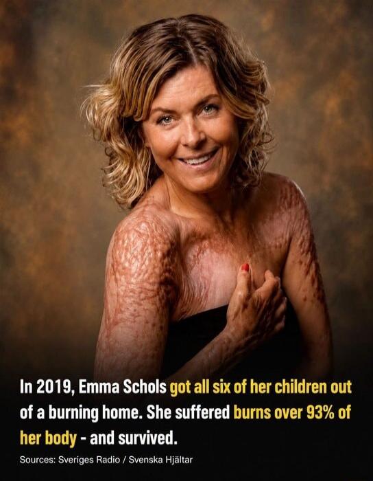 In 2019, Emma Schols got all six of her children out of a burning home. She suffered burns over 93% of her body - and survived. Sources: Sveriges Radio / Svenska Hjältar