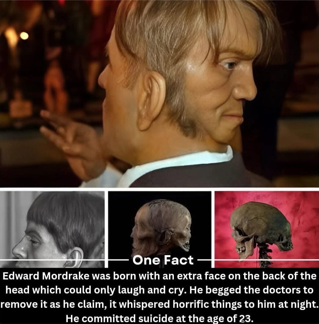 Edward Mordrake was born with an extra face on the back of the head which could only laugh and cry He begged the doctors to remove it as he claim it whispered horrific things to him at night He committed suicide at the age of 23