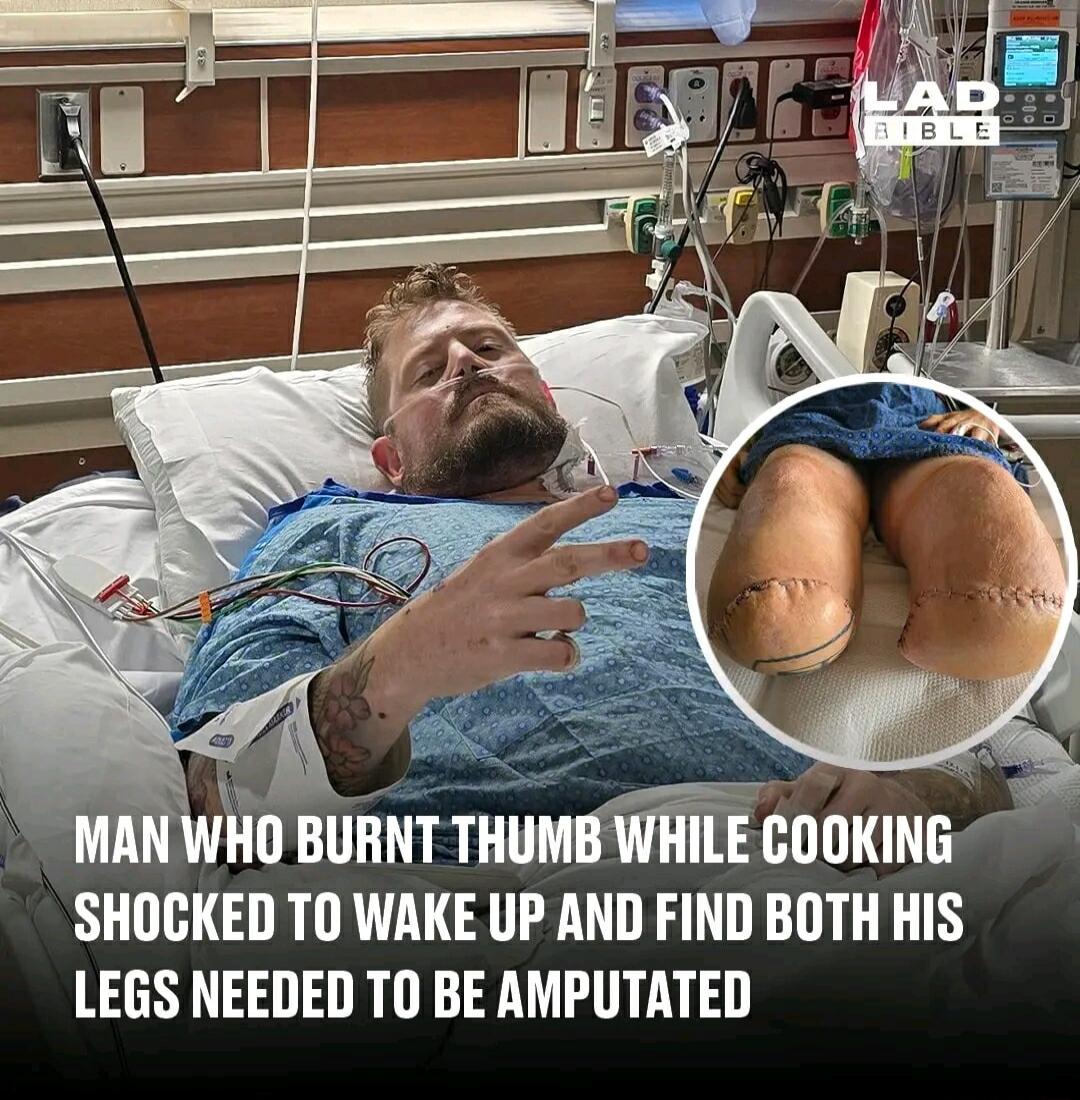 JAN WHO BURNT THUMBWHILE COOKING SHOCKED TO WAKE UP AND FIND BOTH HIS LEGS NEEDED T0 BE AWPUTATED