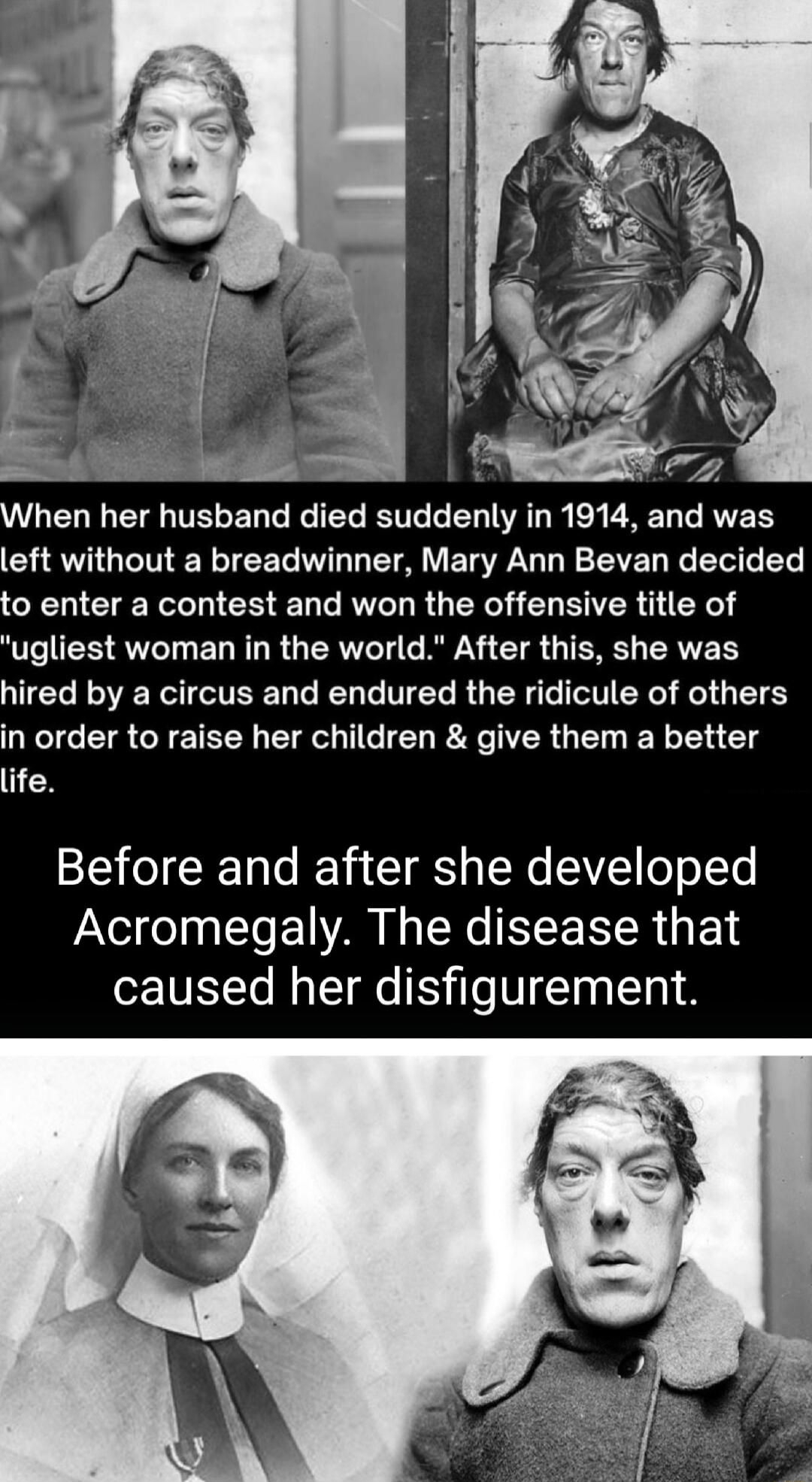 L7 hen her husband died suddenly in 1914 and was CHEVIGEINERTCEL L LT EG L EVED e T T o enter a contest and won the offensive title of UV EST QT EL R R RN RN GG TR RV hired by a circus and endured the ridicule of others in order to raise her children give them a better life Before and after she developed Acromegaly The disease that caused her disfigurement