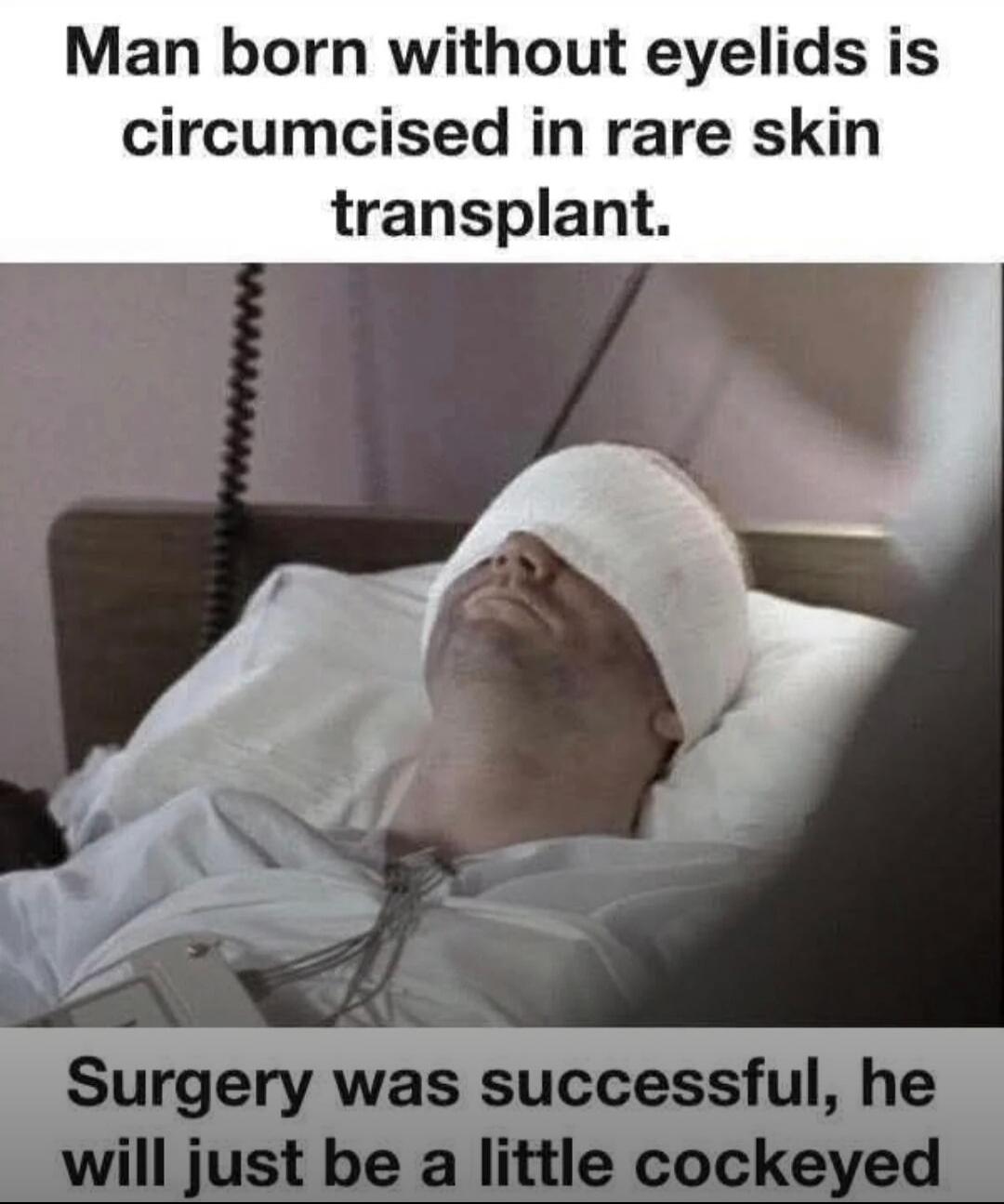 Man born without eyelids is circumcised in rare skin transplant. Surgery was successful, he will just be a little cockeyed