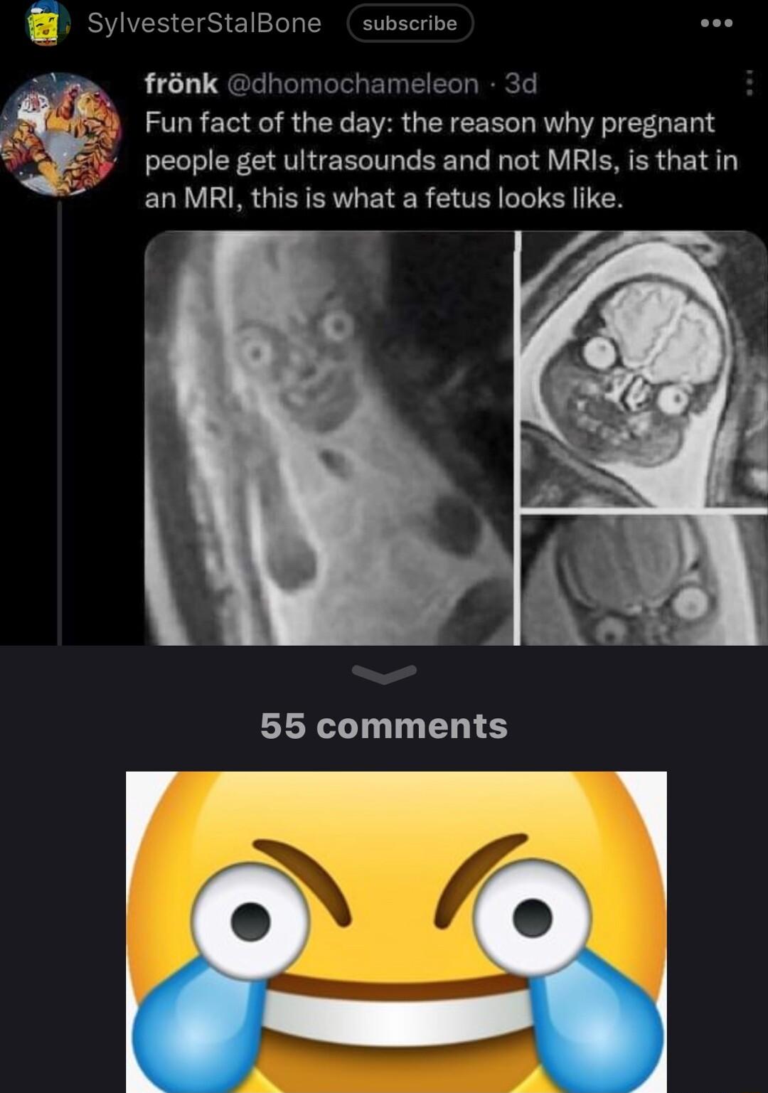 SylvesterStalBone subscribe frnk dhomochameleon 3d Fun fact of the day the reason why pregnant people get ultrasounds and not MRIs is that in an MR this is what a fetus looks like