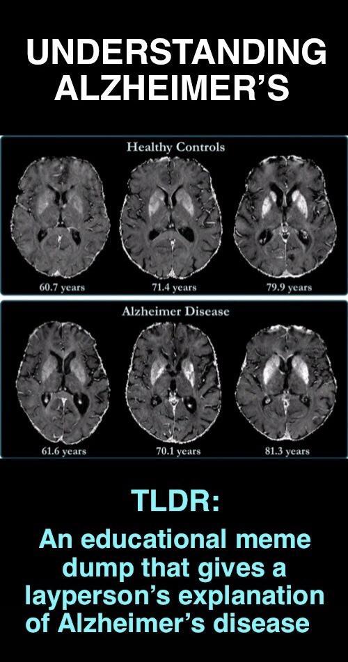 UNDERSTANDING ALZHEIMERS Healthy Controls ity N TLDR An educational meme dump that gives a laypersons explanation o ANPA 1 T o Je ETEE BT