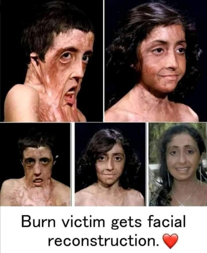 Burn victim gets facial reconstruction