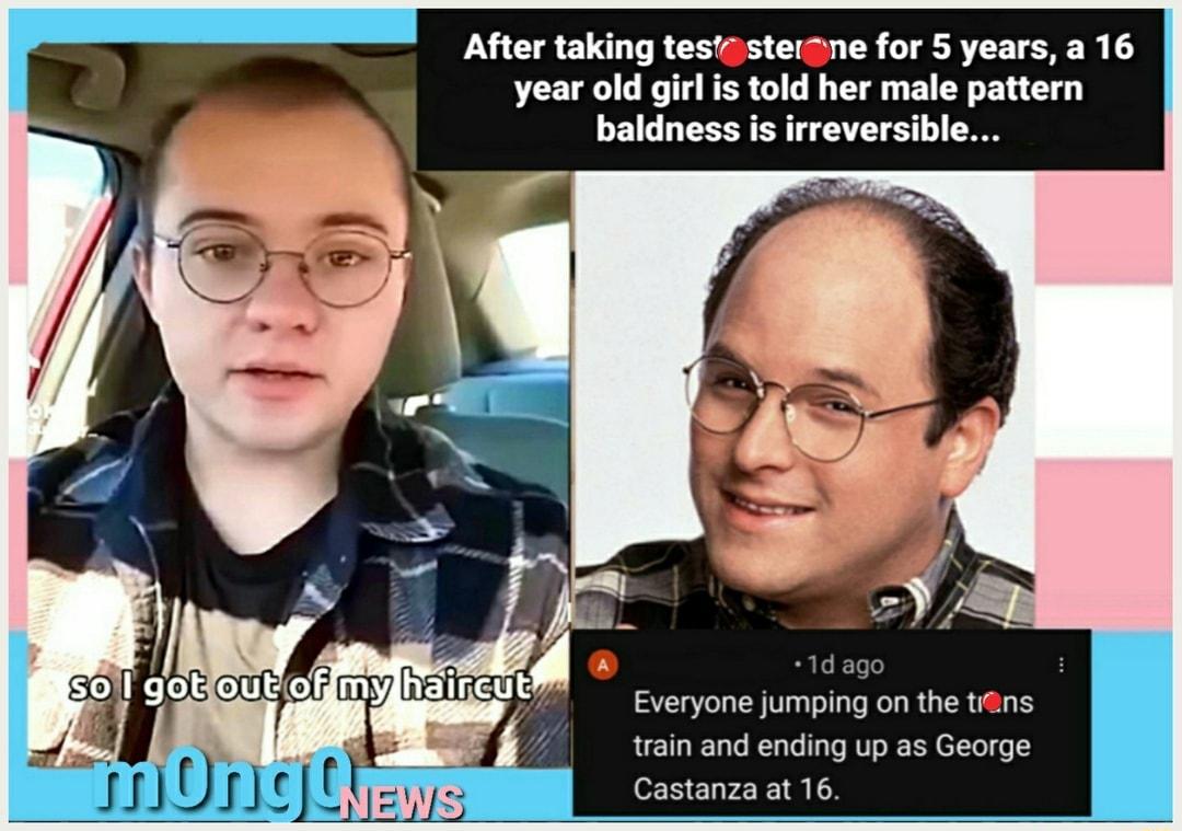 After taking testasteiane for 5 years a 16 year old girlis told her male pattern baldness is irreversible Everyone jumping on the te train and ending up as George