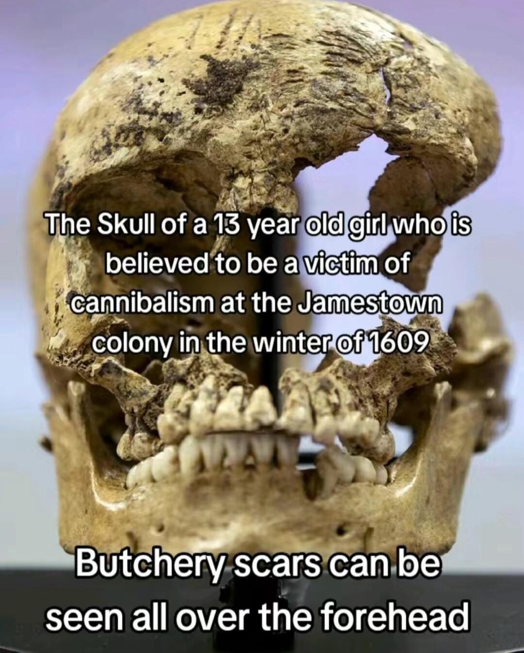 Tkrye Skull of a13 year believedto be alVictim of seen all over the forehead
