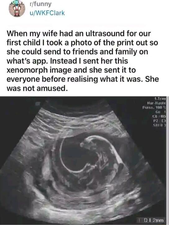 When my wife had an ultrasound for our first child took a photo of the print out so she could send to friends and family on whats app Instead sent her this xenomorph image and she sent it to everyone before realising what it was She was not amused
