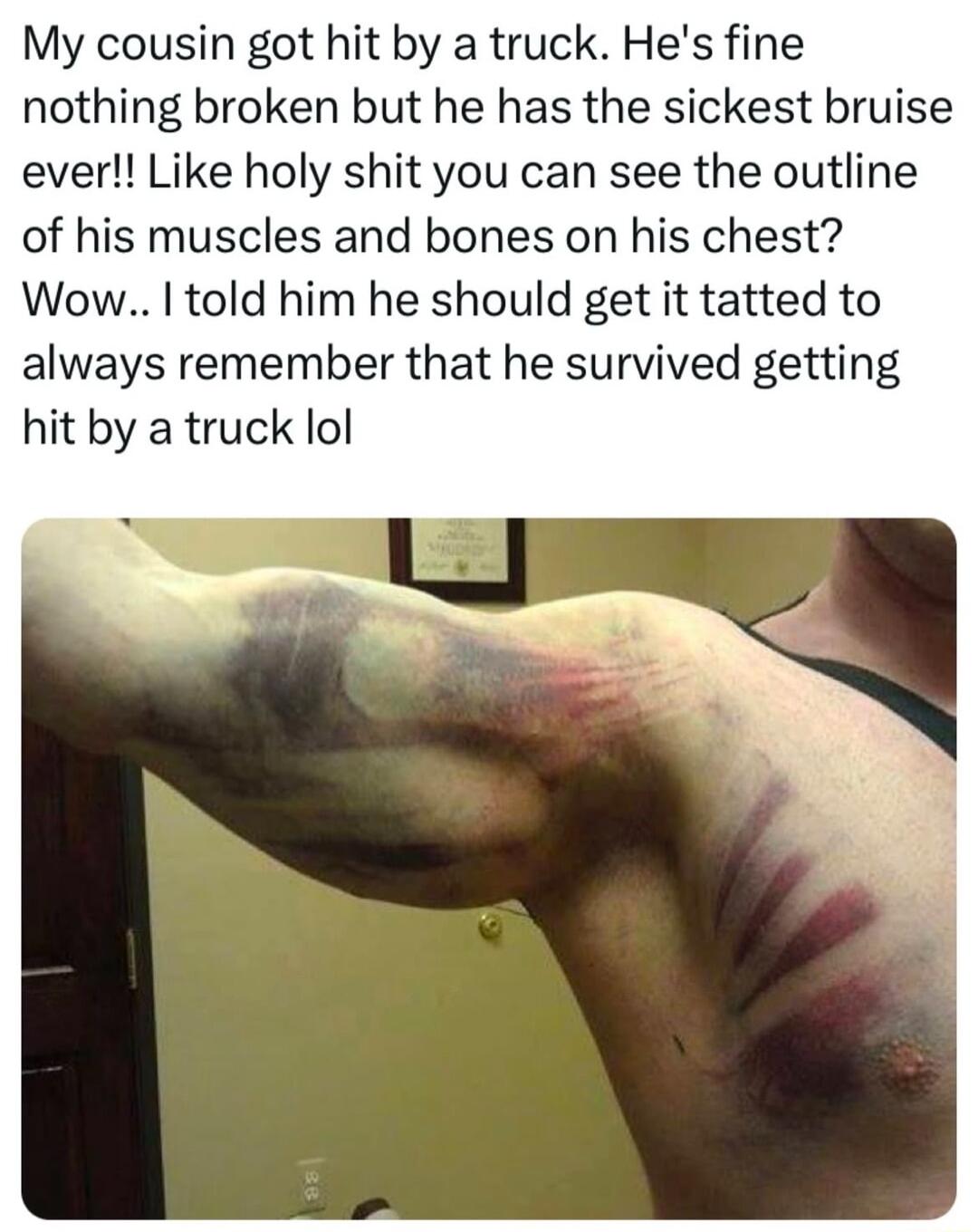 My cousin got hit by a truck Hes fine nothing broken but he has the sickest bruise ever Like holy shit you can see the outline of his muscles and bones on his chest Wow told him he should get it tatted to always remember that he survived getting hit by a truck lo