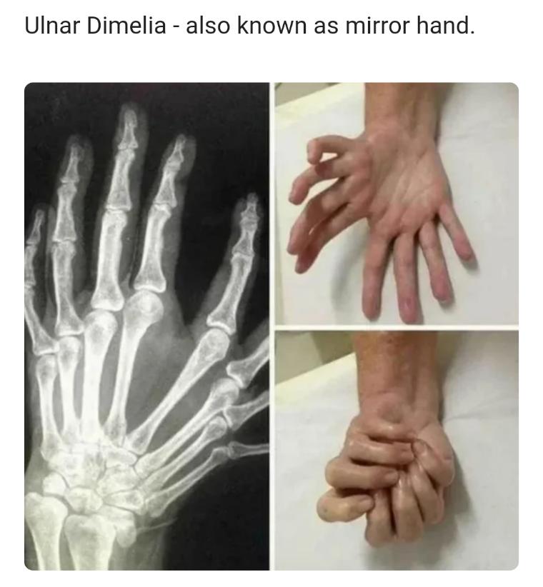 Ulnar Dimelia also known as mirror hand