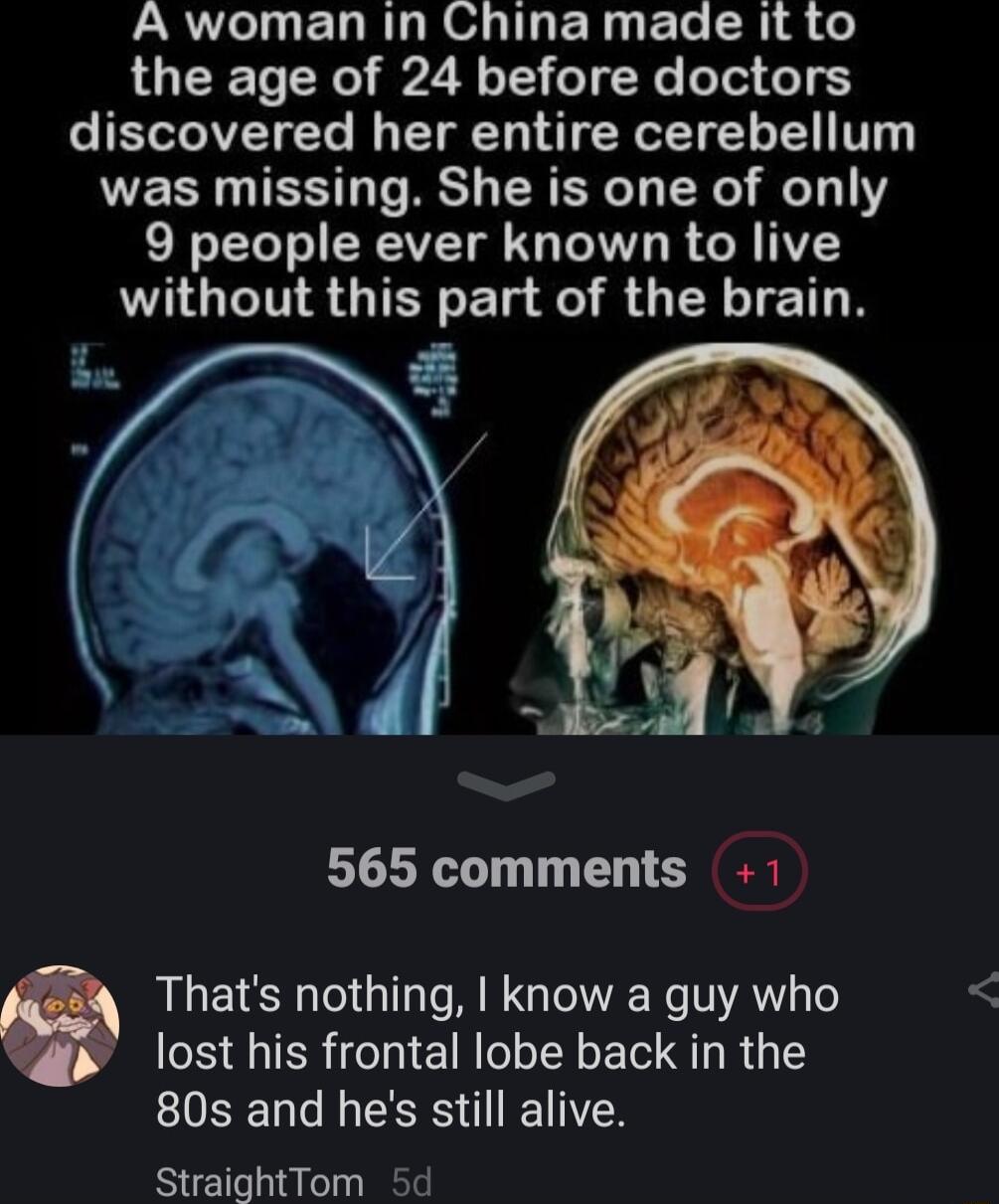 A woman in China made it to the age of 24 before doctors IETTAVEYYe I T D ERGTT TR V was missing She is one of only 9 people ever known to live without this part of the brain 565 comments 1 Thats nothing know a guy who lost his frontal lobe back in the 80s and hes still alive StraightTom 5d