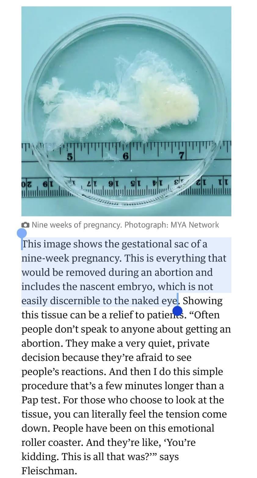 Nine weeks of pregnancy Photograph MYA Network This image shows the gestational sac of a nine week pregnancy This is everything that would be removed during an abortion and includes the nascent embryo which is not easily discernible to the naked eye Showing this tissue can be a relief to patieff Often people dont speak to anyone about getting an abortion They make a very quiet private decision bec