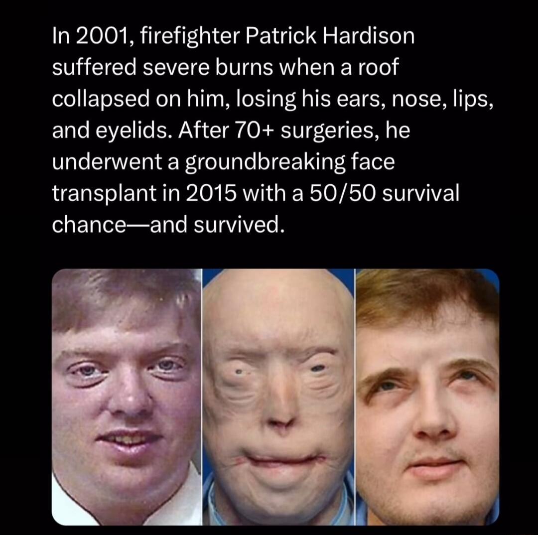 In 2001 firefighter Patrick Hardison EUEEREEEL TG EL TGl collapsed on him losing his ears nose lips and eyelids After 70 surgeries he underwent a groundbreaking face transplant in 2015 with a 5050 survival chanceand survived