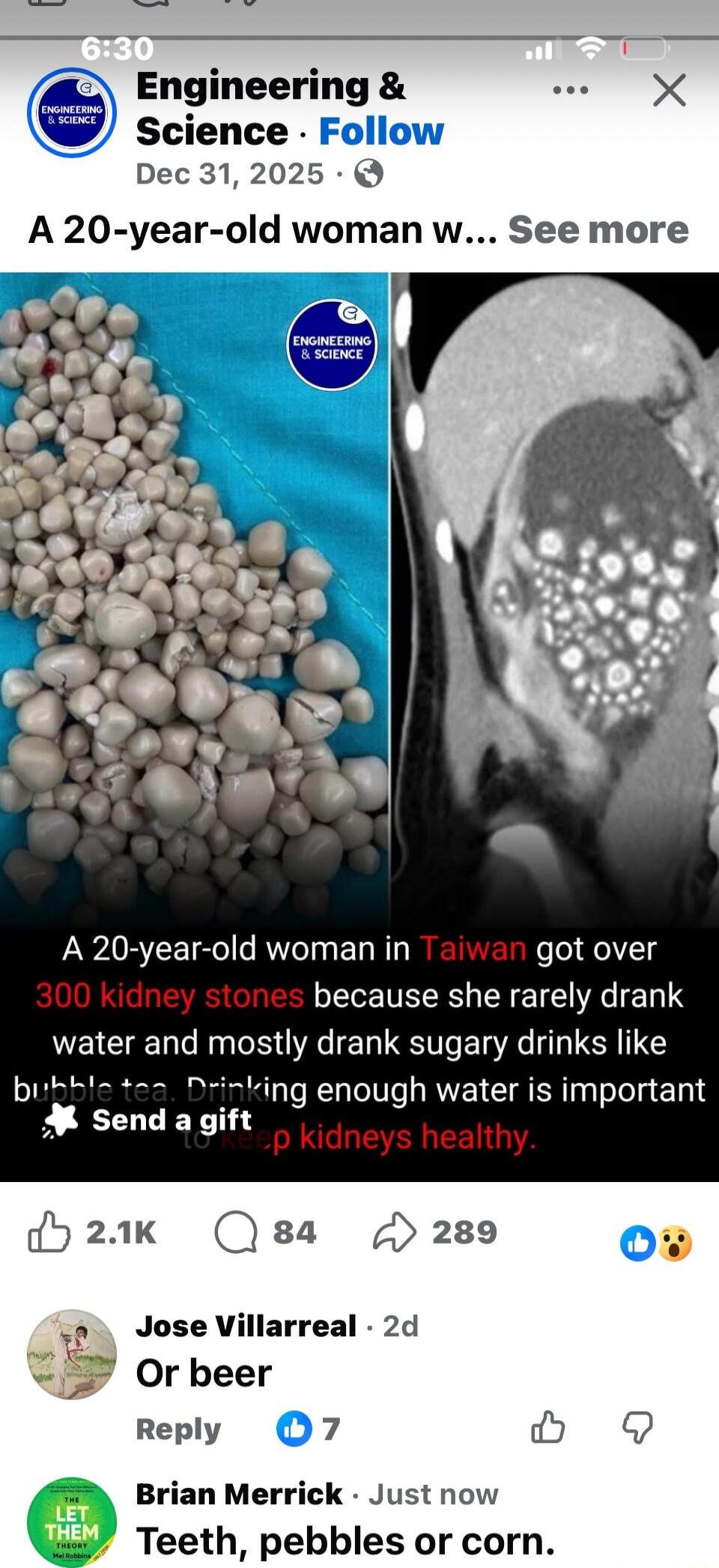 A 20-year-old woman in Taiwan got over 300 kidney stones because she rarely drank water and mostly drank sugary drinks like bubble tea. Drinking enough water is important to keep your kidneys healthy.