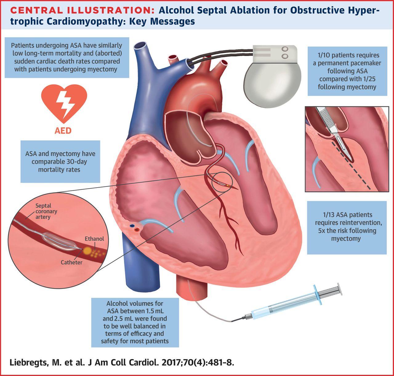 LLUST m 10N Alcohol Septal Ablatlon for Obstructive Hyper rduomyopathy Key Messages Liebregts M et al J Am Coll Cardiol 2017704481 8