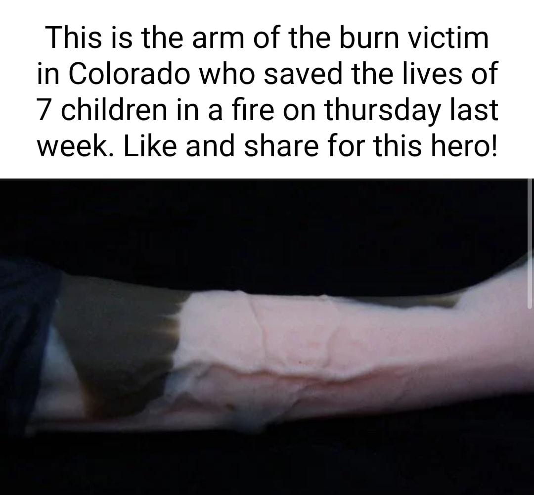 This is the arm of the burn victim in Colorado who saved the lives of 7 children in a fire on thursday last week Like and share for this hero