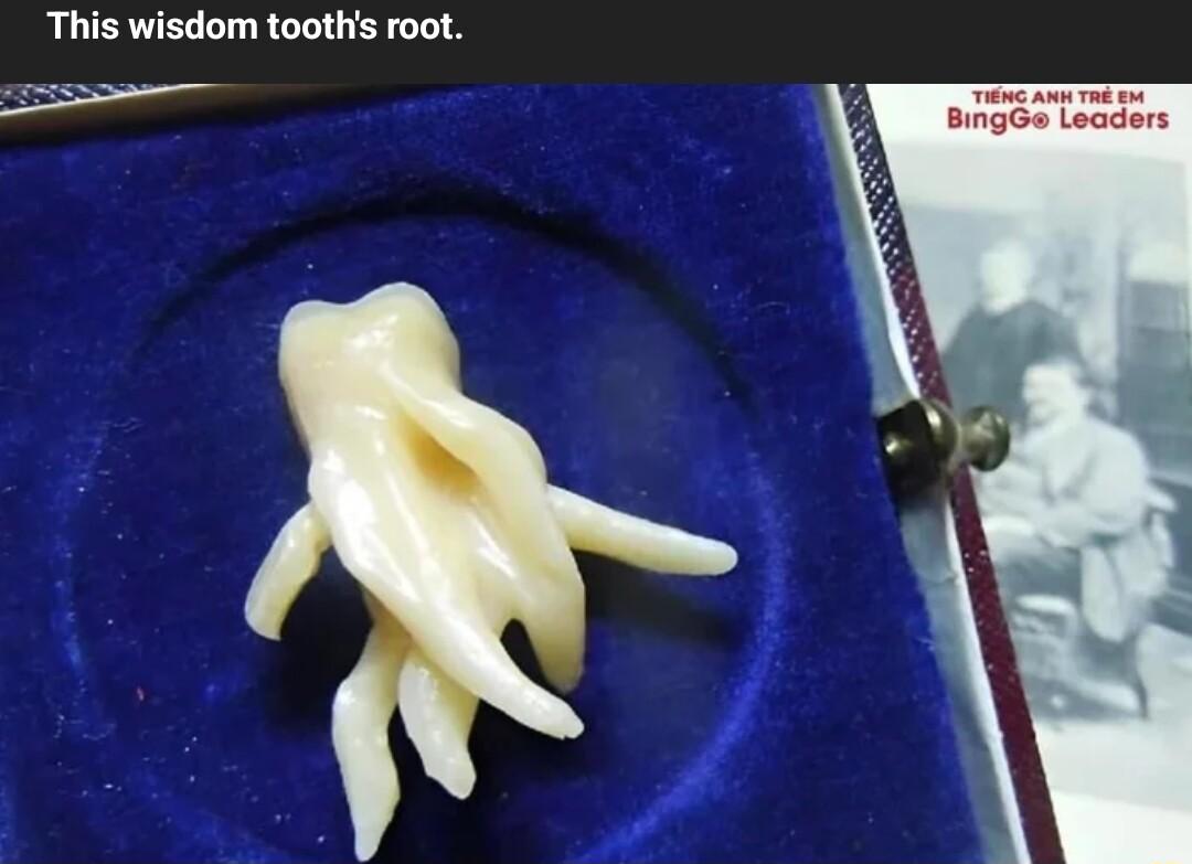 This wisdom tooths root S