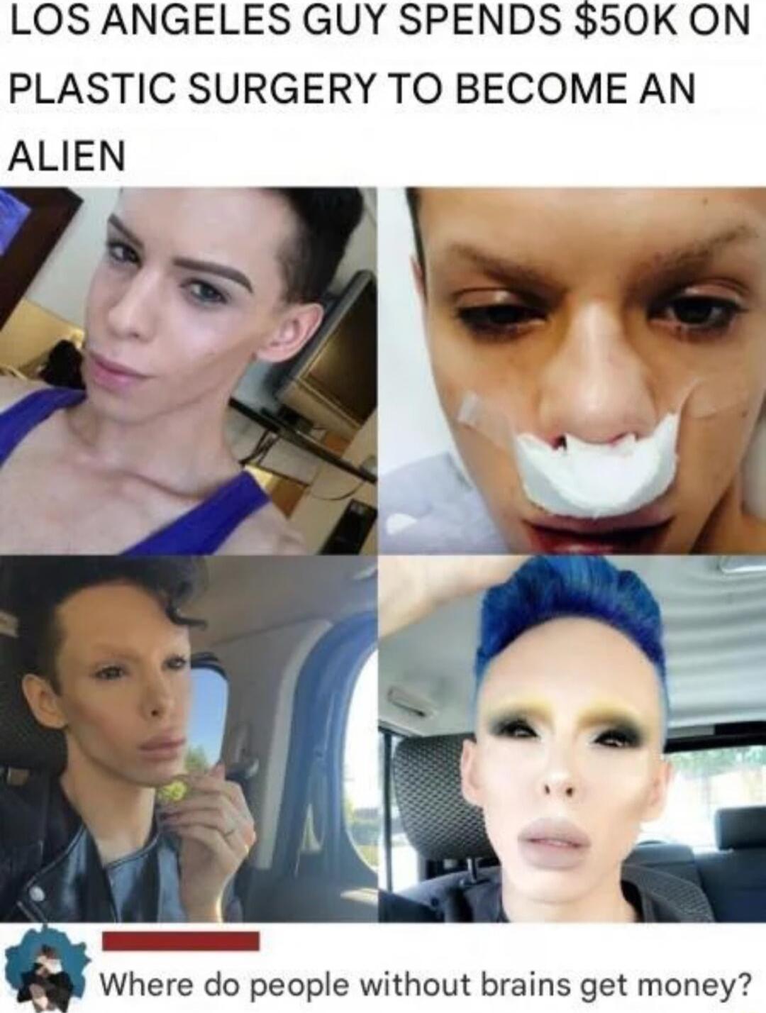LOS ANGELES GUY SPENDS 50K ON PLASTIC SURGERY TO BECOME AN Where do people without brains get money