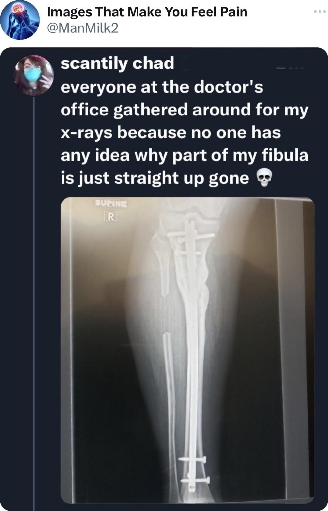 ELET TR BT everyone at the doctors office gathered around for my b EVEN L TEE T R Y B VAT CERT A ETa e i YA 1 1 is just straight up gone