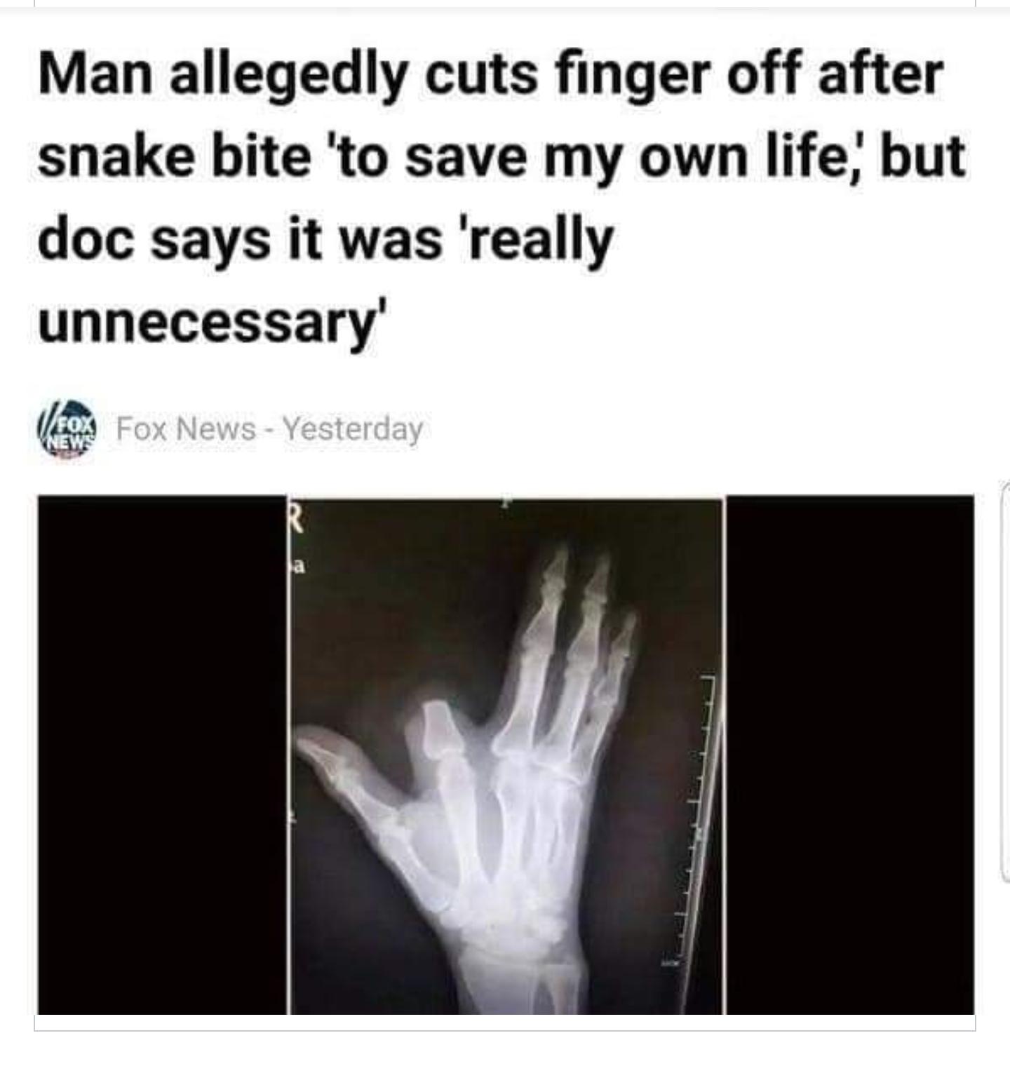 Man allegedly cuts finger off after snake bite to save my own life but doc says it was really unnecessary o e