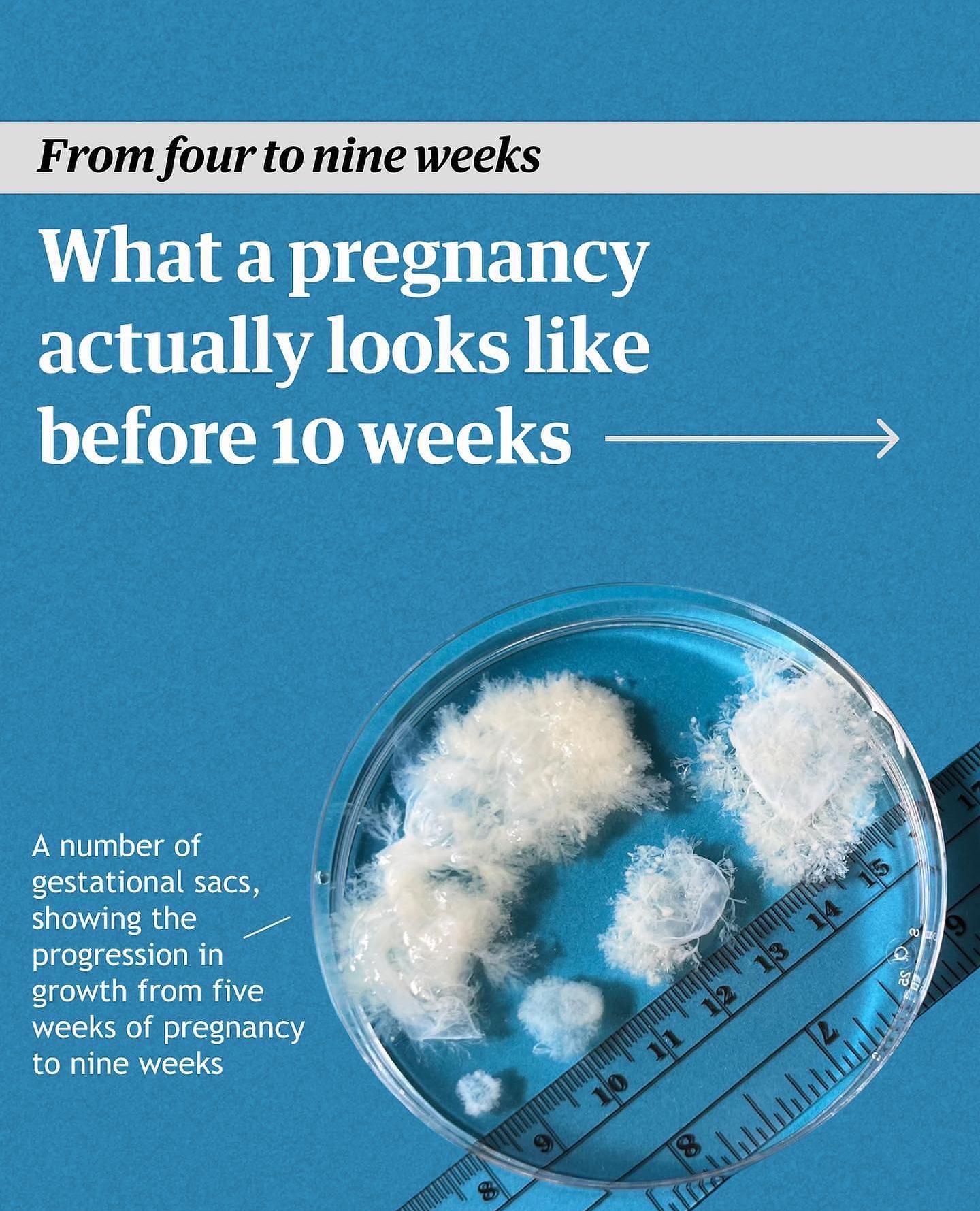 What a pregnancy actually looks like before 10 weeks