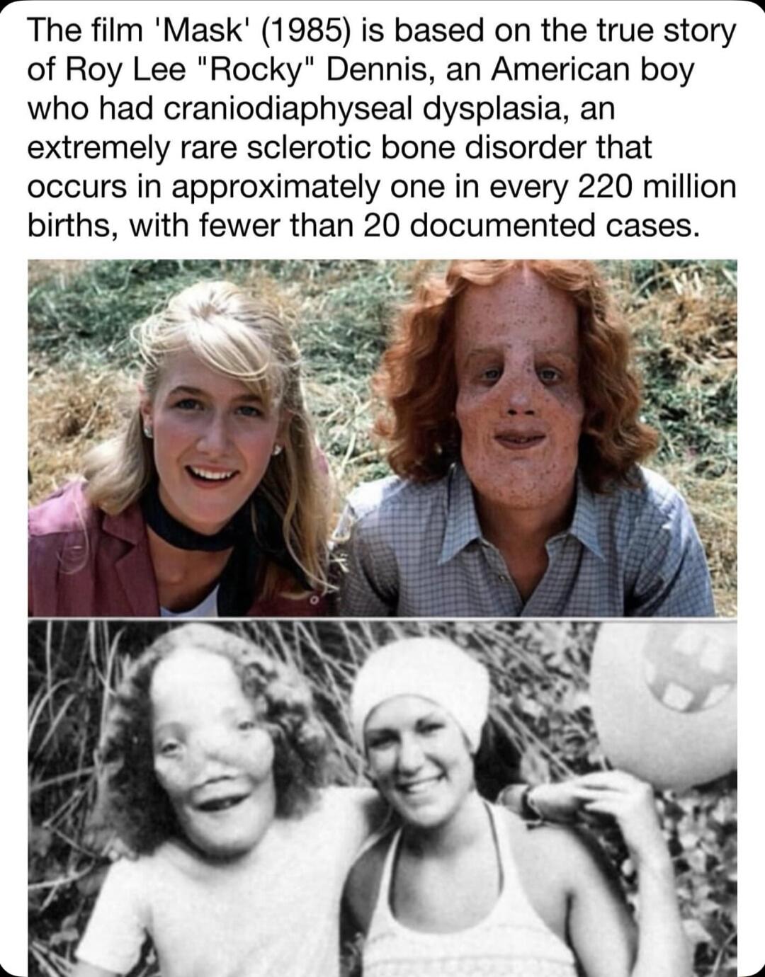 The film Mask 1985 is based on the true story of Roy Lee Rocky Dennis an American boy who had craniodiaphyseal dysplasia an extremely rare sclerotic bone disorder that occurs in approximately one in every 220 million births with fewer than 20 documented cases i v Lo